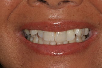 Invisalign 