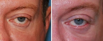 Lower eyelid reconstruction 