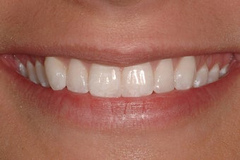 Porcelain Veneers