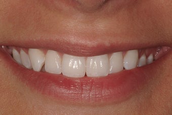 Porcelain Veneers