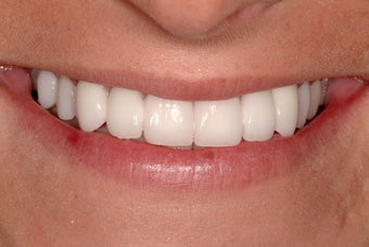 Bridges and Veneers