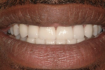 Porcelain Veneers
