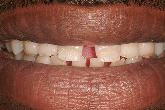 Porcelain Veneers