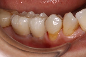 Implant restorations 