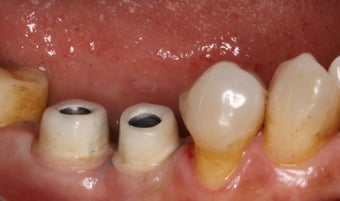 Implant restorations 