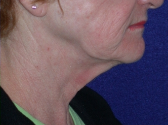 Necklift