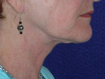 Necklift