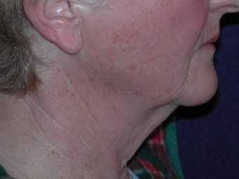 Necklift