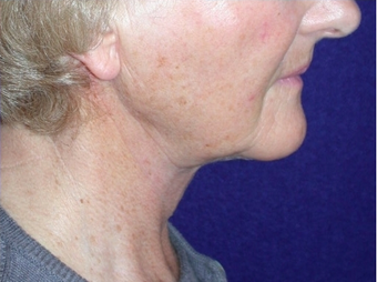 Necklift