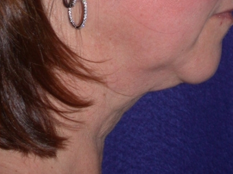Necklift