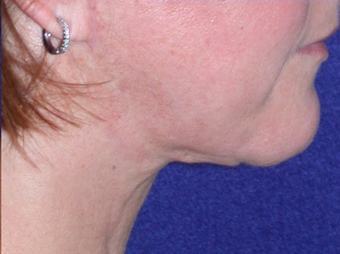 Necklift