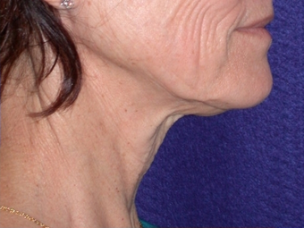 Necklift