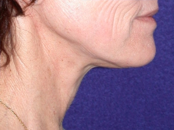 Necklift