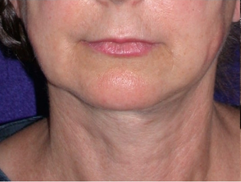 Necklift