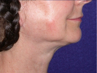 Necklift