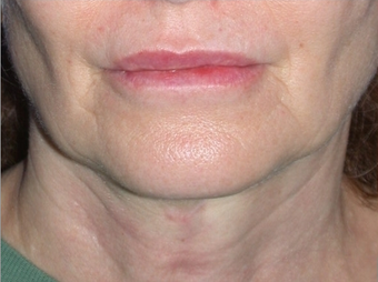 Necklift