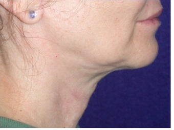 Necklift