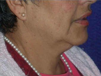 Necklift