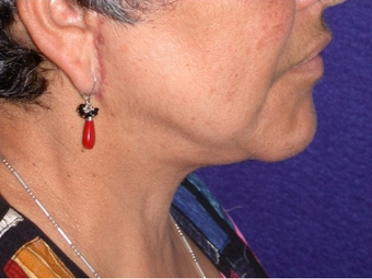 Necklift