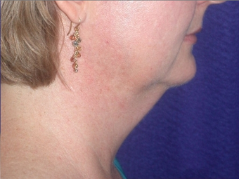 Necklift