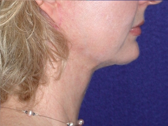 Necklift