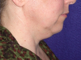 Necklift