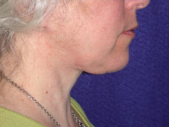 Necklift