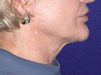 Necklift