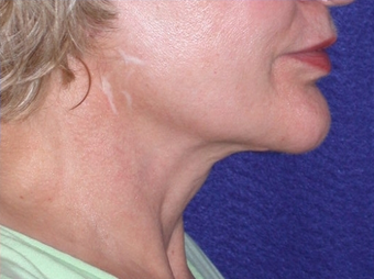 Necklift
