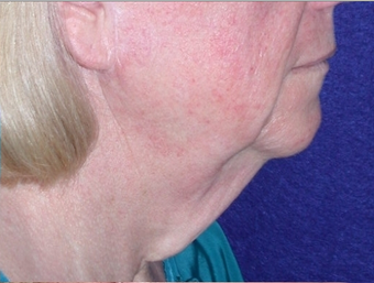 Necklift