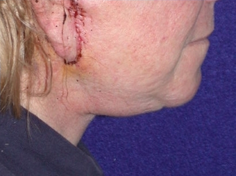 Necklift