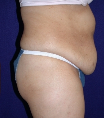 abdominoplasty