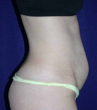 Tummy Tuck (abdominoplasty)