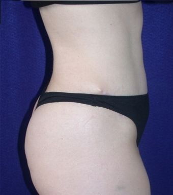 Tummy Tuck (abdominoplasty)