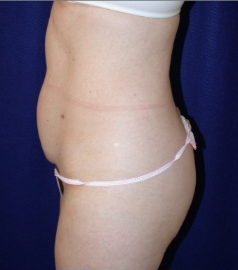 Tummy Tuck (abdominoplasty)