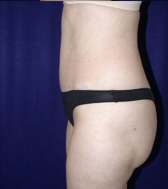 Tummy Tuck (abdominoplasty)