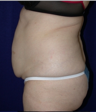 Tummy Tuck (abdominoplasty)