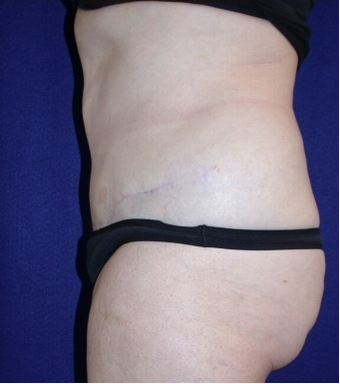 Tummy Tuck (abdominoplasty)