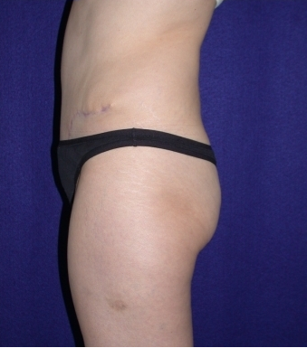 Tummy Tuck (abdominoplasty)