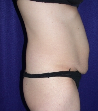 Tummy Tuck (abdominoplasty)