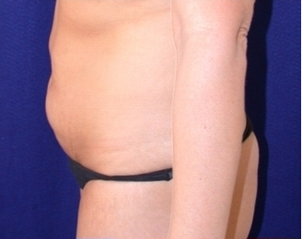 Mini Tummy Tuck