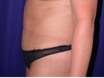 Mini Tummy Tuck