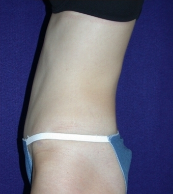 Tummy Tuck (abdominoplasty)