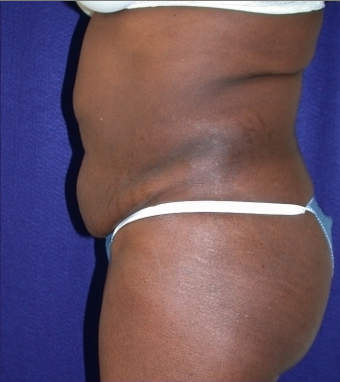 Tummy Tuck (abdominoplasty)