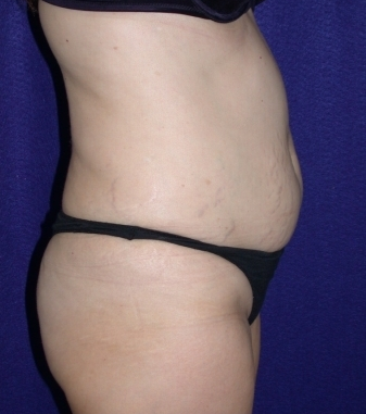 Tummy Tuck (abdominoplasty)