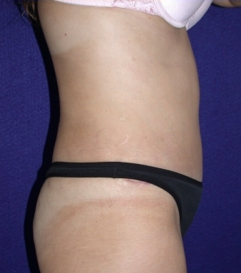 Tummy Tuck (abdominoplasty)