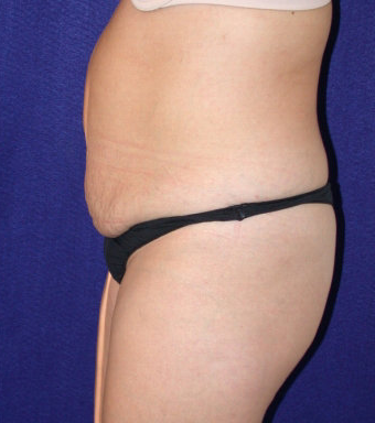Tummy Tuck (abdominoplasty)