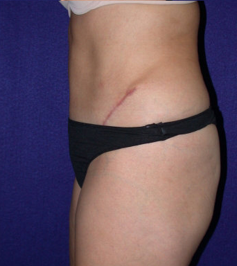 Tummy Tuck (abdominoplasty)
