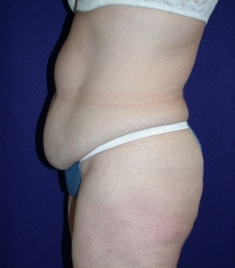 Tummy Tuck (abdominoplasty)