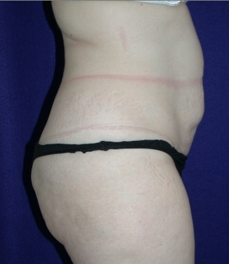 Tummy Tuck (abdominoplasty)